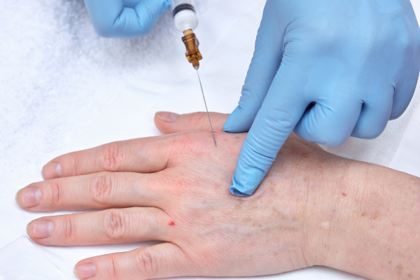 Perineural Injection Therapy (PIT Perineural Injection Therapy (PIT) in Pembroke Pines, Miramar