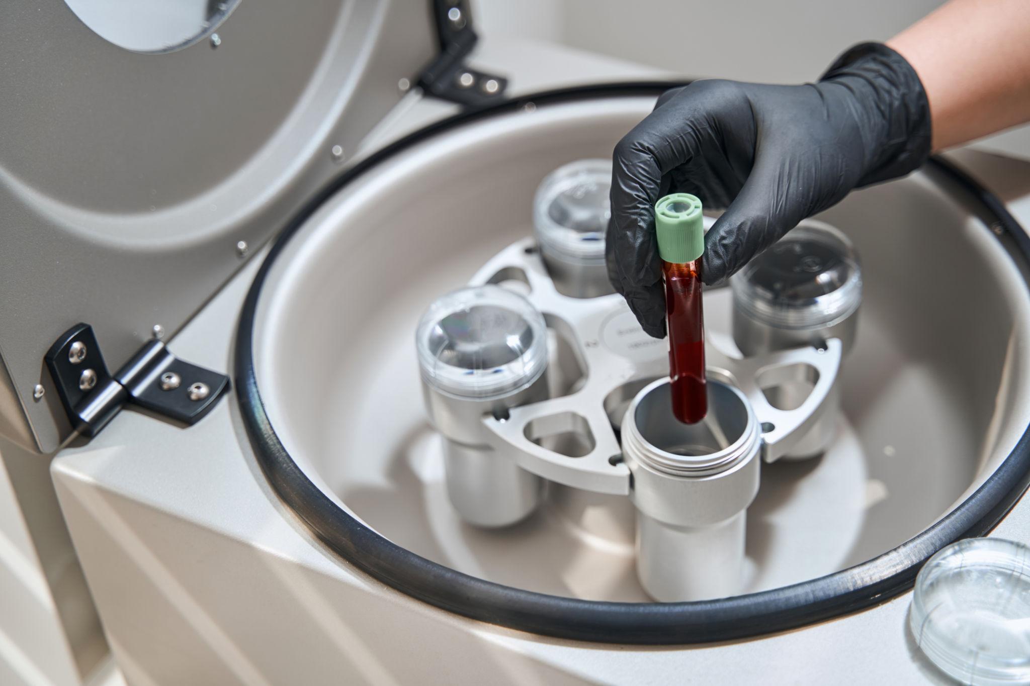 PRP Platelet Therapy Pembroke Pines Vita Health Dr Pakula PRP Platelet Therapy Pembroke Pines Vita Health Dr Pakula